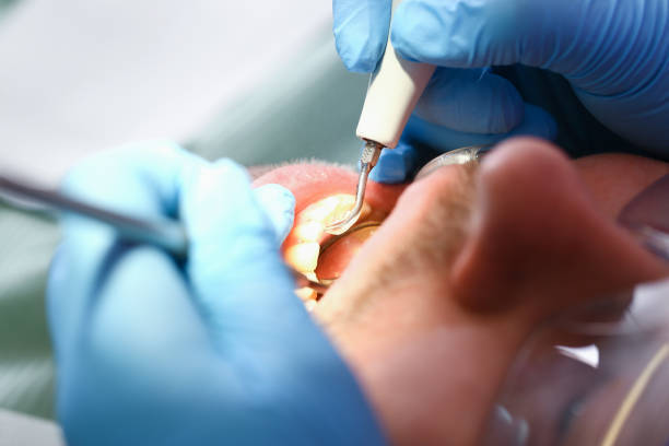 Best Emergency Tooth Extraction in Hamilton City, CA